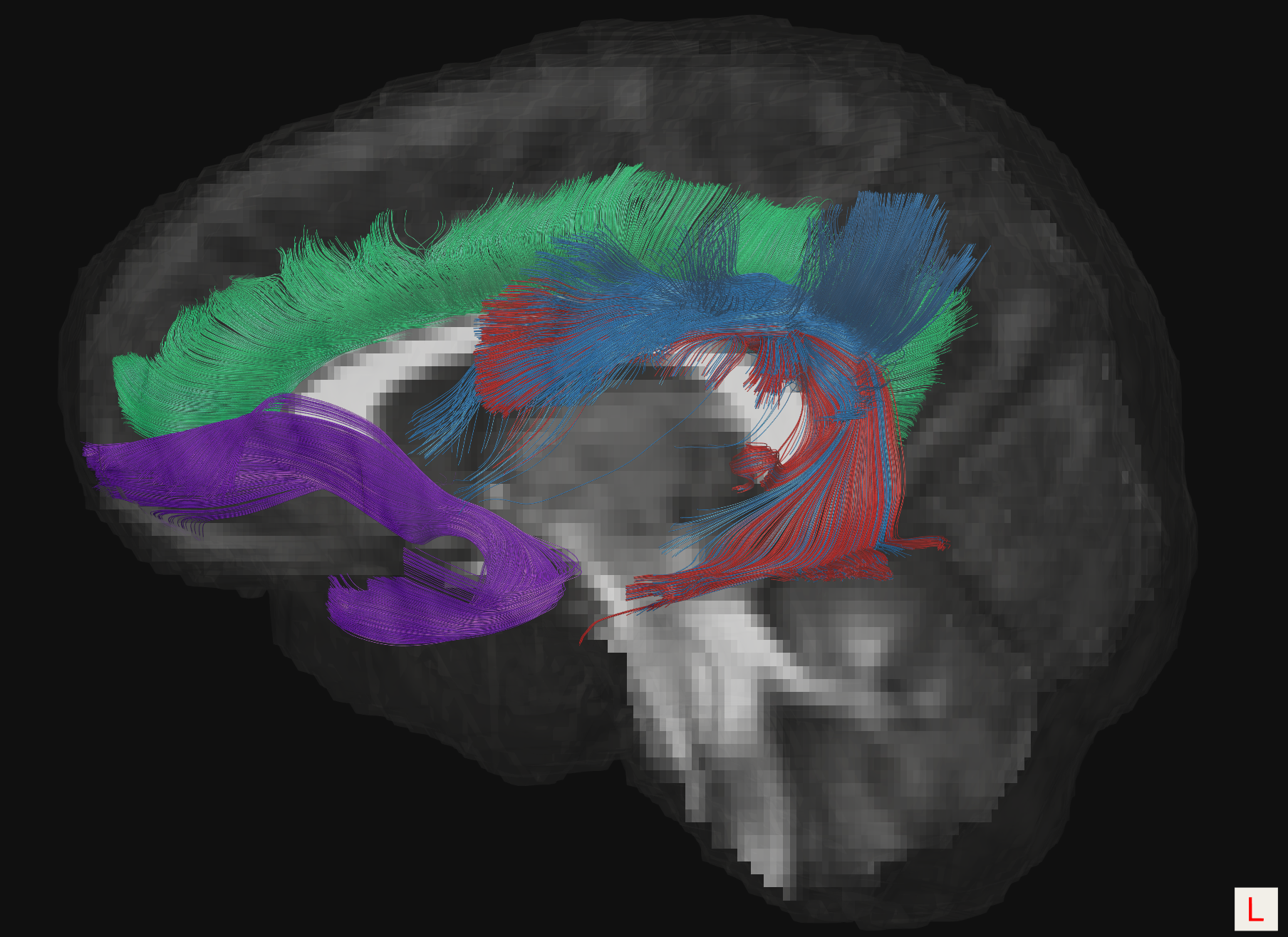 3D tractography