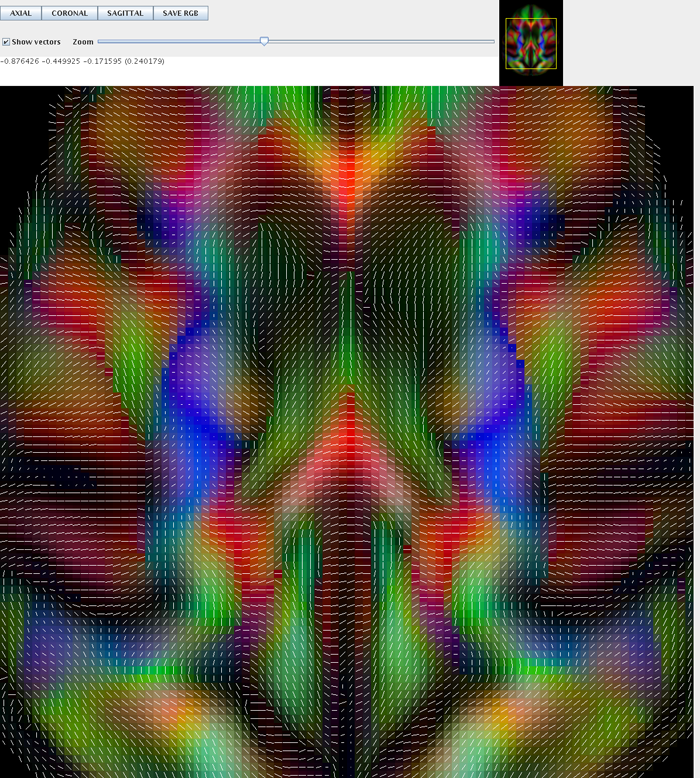 Tensor directions axial